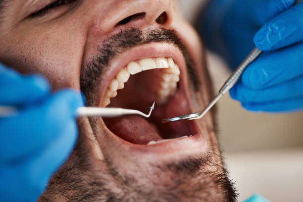 Best Emergency Wisdom Tooth Extraction in Garnett, KS